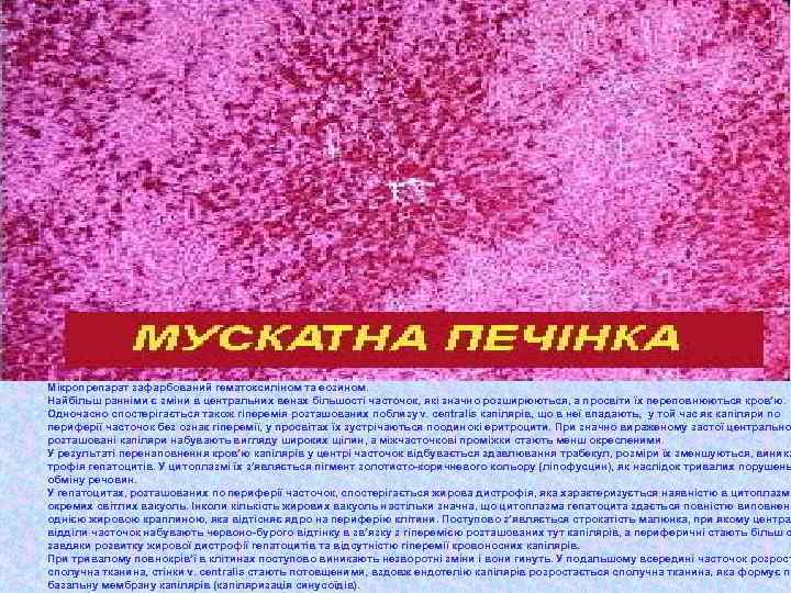 Мікропрепарат зафарбований гематоксиліном та еозином. Найбільш ранніми є зміни в центральних венах більшості часточок,