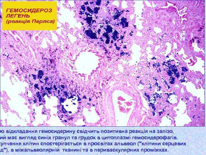 ро відкладання гемосидерину свідчить позитивна реакція на залізо, ий має вигляд синіх гранул та