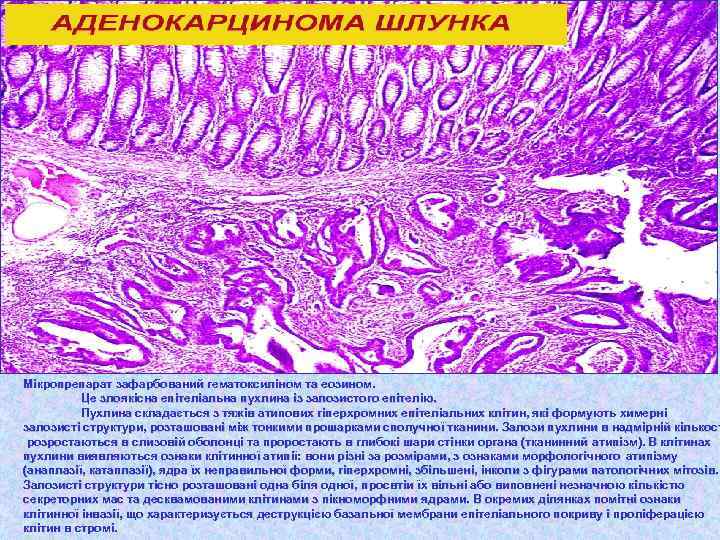 Мікропрепарат зафарбований гематоксиліном та еозином. Це злоякісна епітеліальна пухлина із залозистого епітелію. Пухлина складається