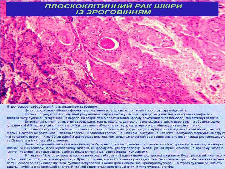 Мікропрепарат зафарбований гематоксиліном та еозином. Це високо диференційована форма раку, яка виникає із зародкового