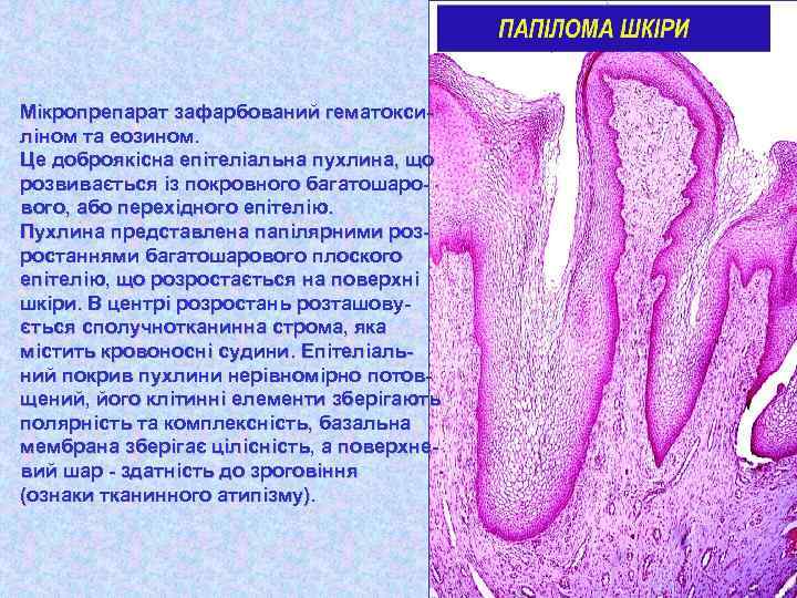Мікропрепарат зафарбований гематоксиліном та еозином. Це доброякісна епітеліальна пухлина, що розвивається із покровного багатошарового,