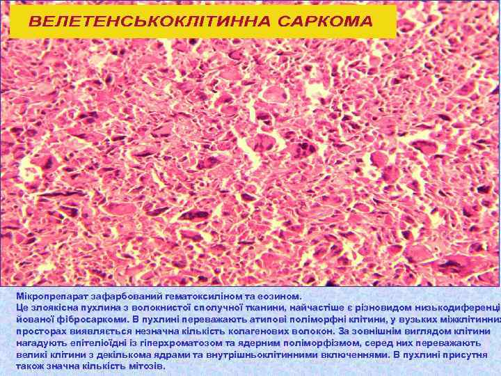 Мікропрепарат зафарбований гематоксиліном та еозином. Це злоякісна пухлина з волокнистої сполучної тканини, найчастіше є