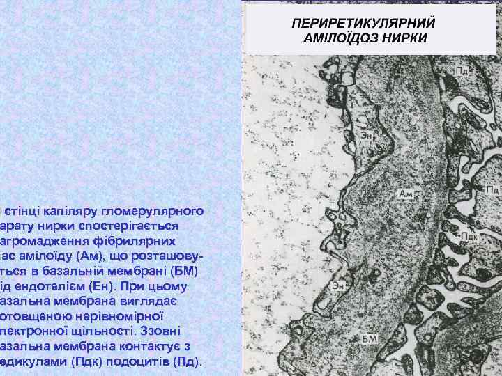 В стінці капіляру гломерулярного арату нирки спостерігається агромадження фібрилярних мас амілоїду (Ам), що розташовуться