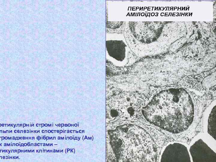 ретикулярній стромі червоної льпи селезінки спостерігається громадження фібрил амілоїду (Ам) ж амілоїдобластами – тикулярними
