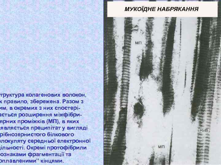 Структура колагенових волокон, к правило, збережена. Разом з им, в окремих з них спостеріається