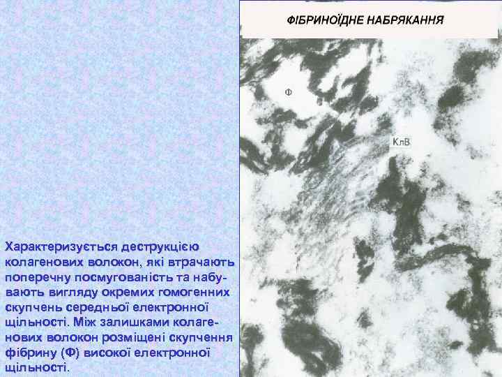 Характеризується деструкцією колагенових волокон, які втрачають поперечну посмугованість та набувають вигляду окремих гомогенних скупчень