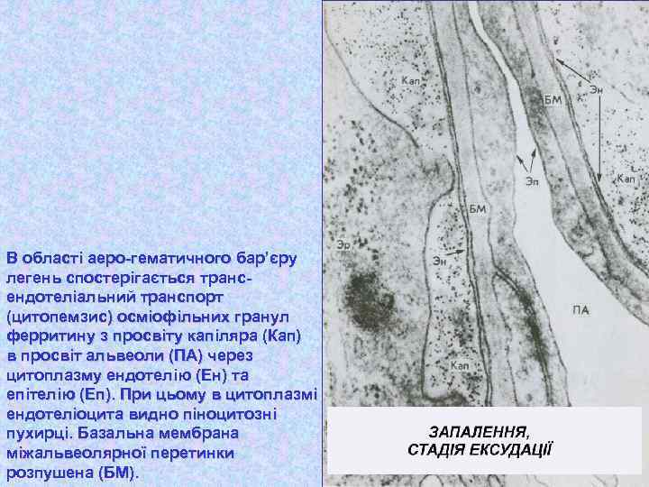 В області аеро-гематичного бар’єру легень спостерігається трансендотеліальний транспорт (цитопемзис) осміофільних гранул ферритину з просвіту