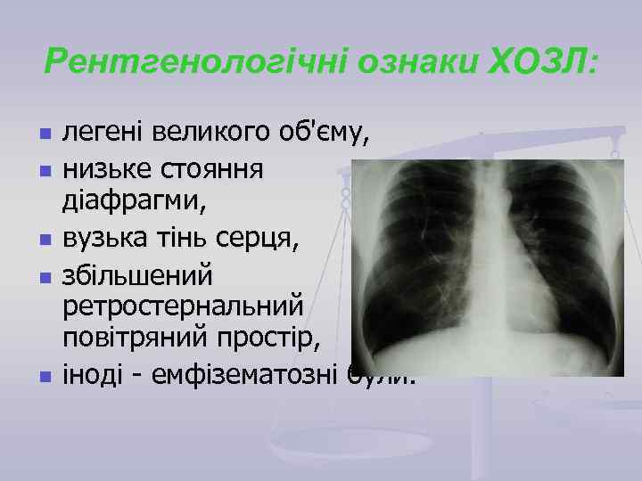 Рентгенологічні ознаки ХОЗЛ: n n n легені великого об'єму, низьке стояння діафрагми, вузька тінь