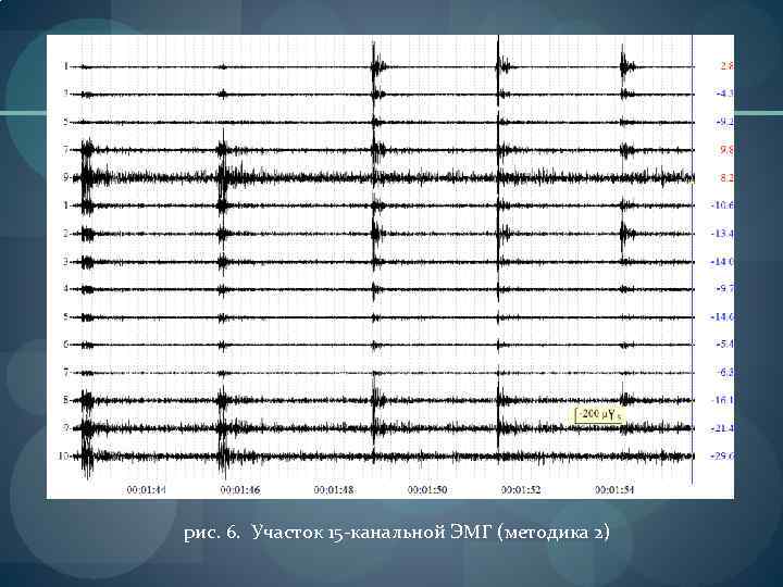 рис. 6. Участок 15 -канальной ЭМГ (методика 2) 