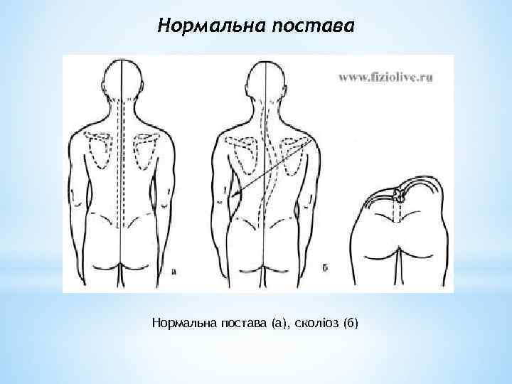 Нормальна постава (а), сколіоз (б) 