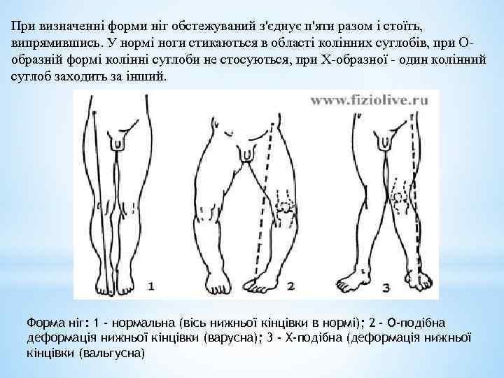 При визначенні форми ніг обстежуваний з'єднує п'яти разом і стоїть, випрямившись. У нормі ноги