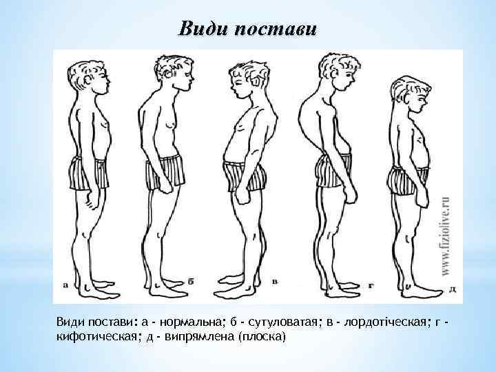 Види постави: а - нормальна; б - сутуловатая; в - лордотіческая; г кифотическая; д