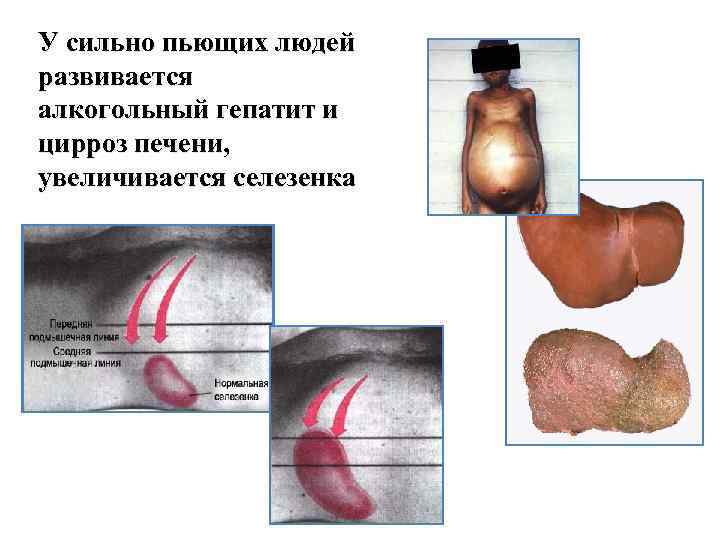 У сильно пьющих людей развивается алкогольный гепатит и цирроз печени, увеличивается селезенка 