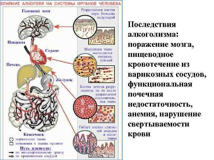 Последствия алкоголизма: поражение мозга, пищеводное кровотечение из варикозных сосудов, функциональная почечная недостаточность, анемия, нарушение