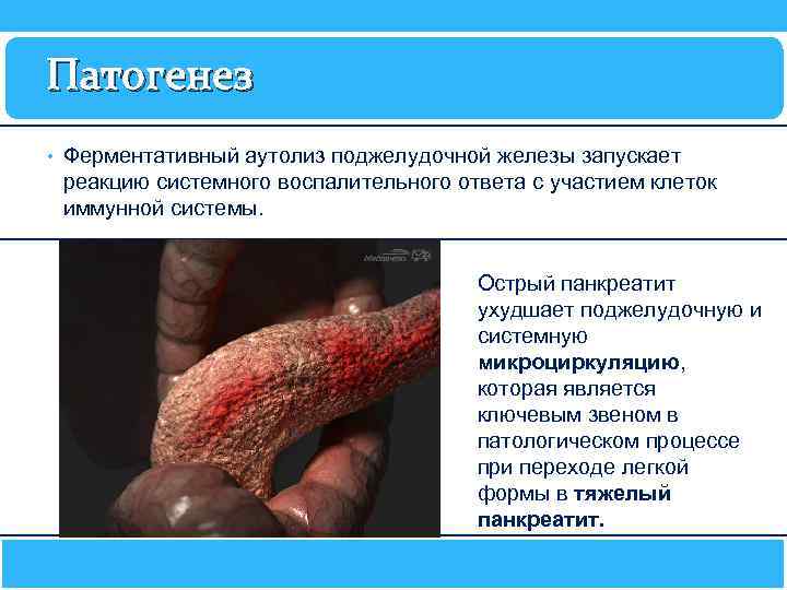 Патогенез • Ферментативный аутолиз поджелудочной железы запускает реакцию системного воспалительного ответа с участием клеток