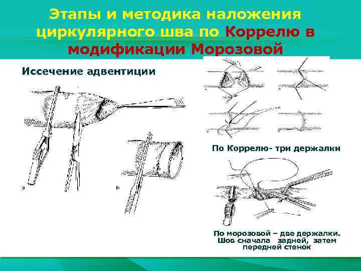 Этапы и методика наложения циркулярного шва по Коррелю в модификации Морозовой Иссечение адвентиции По