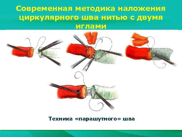 Современная методика наложения циркулярного шва нитью с двумя иглами Техника «парашутного» шва 
