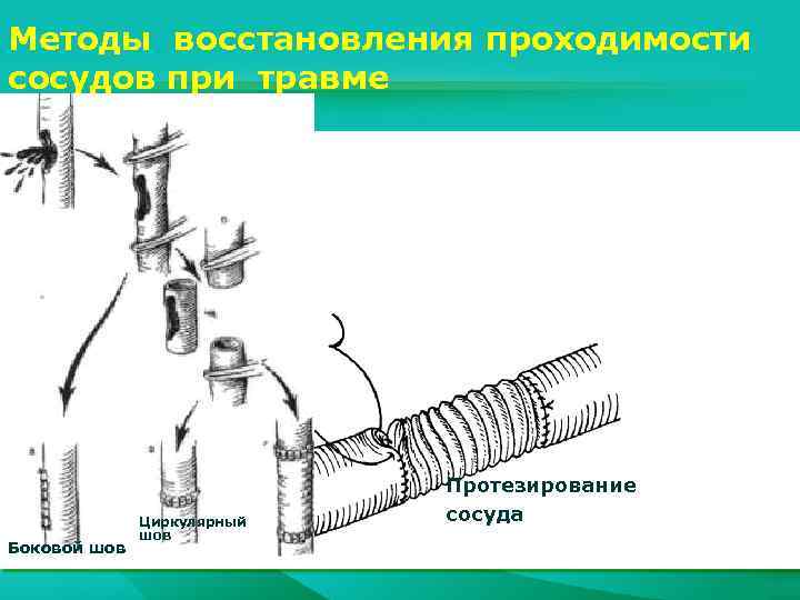 Методы восстановления проходимости сосудов при травме Боковой шов Циркулярный шов Протезирование сосуда 