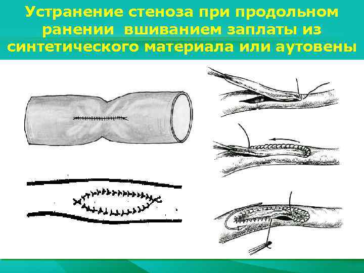 Устранение стеноза при продольном ранении вшиванием заплаты из синтетического материала или аутовены 