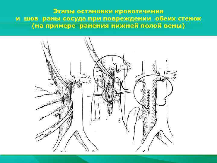 Этапы остановки кровотечения и шов раны сосуда при повреждении обеих стенок (на примере ранения