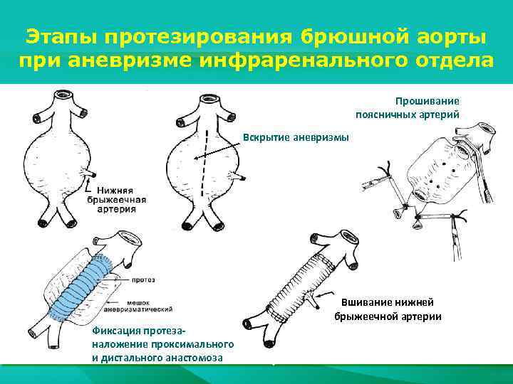 Аневризма аорты карта вызова