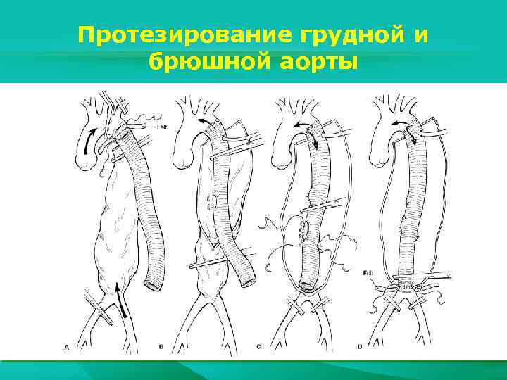 Протезирование грудной и брюшной аорты 