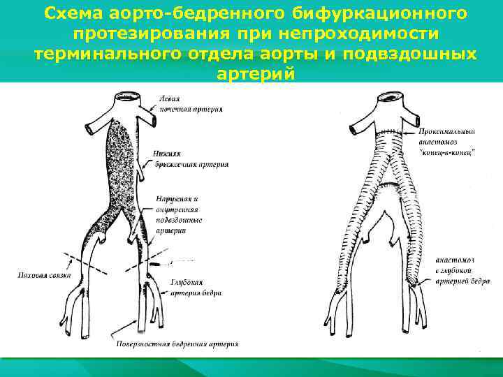 Схема аорто-бедренного бифуркационного протезирования при непроходимости терминального отдела аорты и подвздошных артерий 