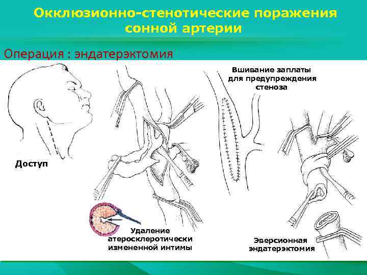 Окклюзионно-стенотические поражения сонной артерии Операция : эндатерэктомия Вшивание заплаты для предупреждения стеноза Доступ Удаление