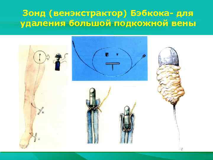 Зонд (венэкстрактор) Бэбкока- для удаления большой подкожной вены 