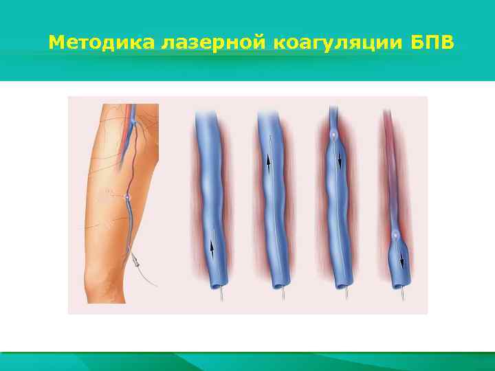 Методика лазерной коагуляции БПВ 