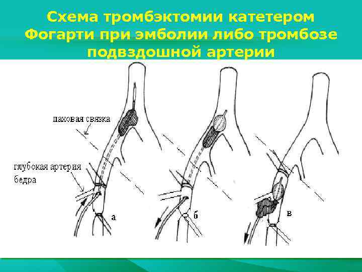 Схема тромбэктомии катетером Фогарти при эмболии либо тромбозе подвздошной артерии 