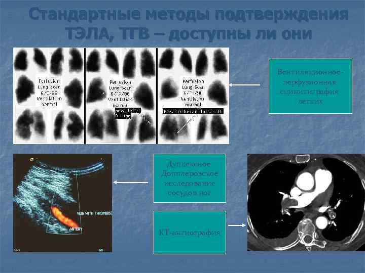 Стандартные методы подтверждения ТЭЛА, ТГВ – доступны ли они Вентиляционноеперфузионная сцинитиграфия легких Дуплексное Допплеровское