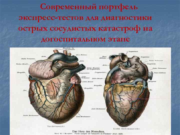 Современный портфель экспресс-тестов для диагностики острых сосудистых катастроф на догоспитальном этапе 