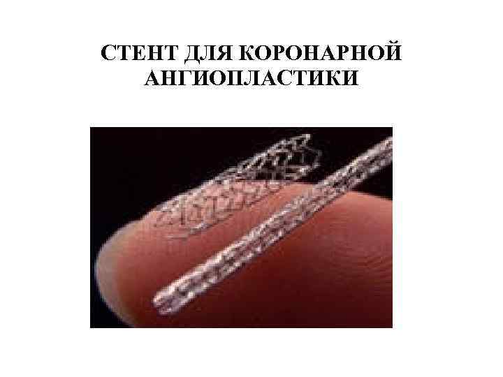 СТЕНТ ДЛЯ КОРОНАРНОЙ АНГИОПЛАСТИКИ 