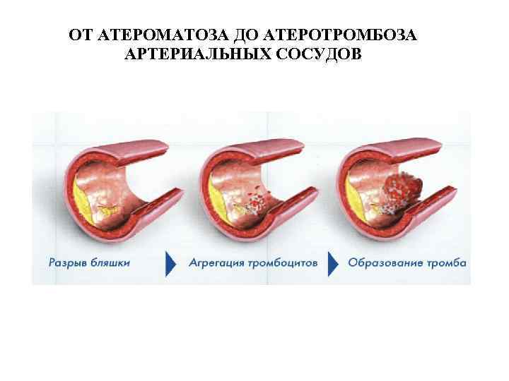 Нестабильная стенокардия прогностически неблагоприятна в плане