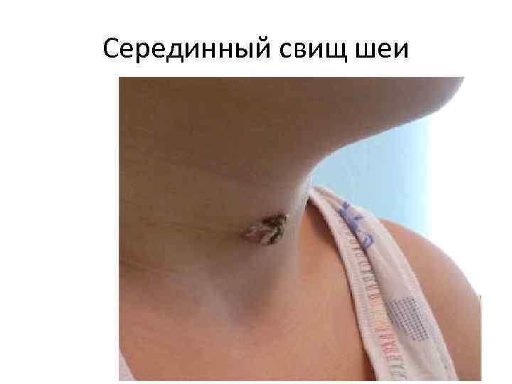 Серединный свищ шеи 