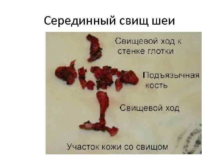 Серединный свищ шеи 