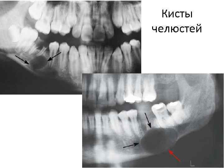 Неодонтогенные кисты презентация