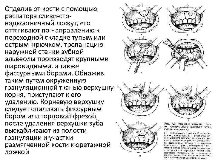 Отделив от кости с помощью распатора слизи-стонадкостничный лоскут, его оттягивают по направлению к переходной