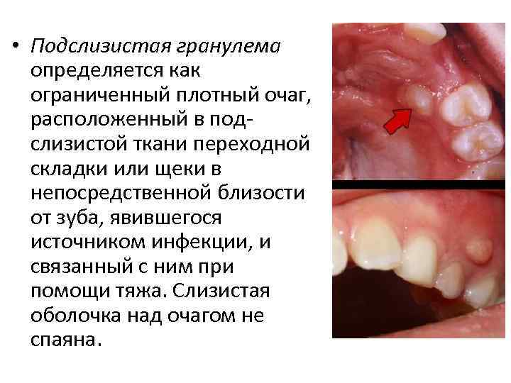  • Подслизистая гранулема определяется как ограниченный плотный очаг, расположенный в подслизистой ткани переходной