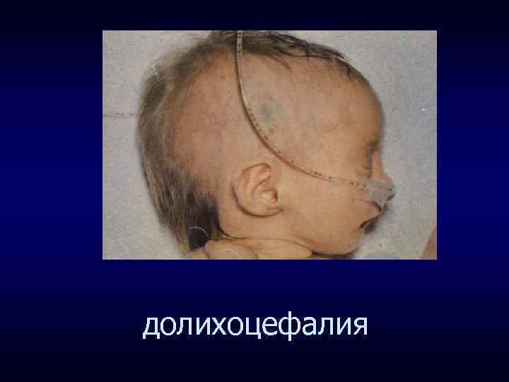 долихоцефалия 