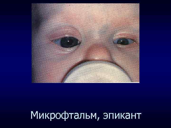 Микрофтальм, эпикант 