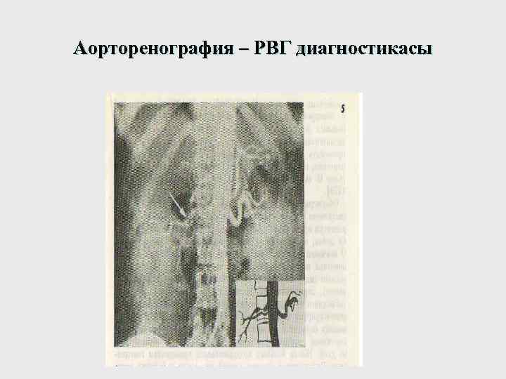 Аорторенография – РВГ диагностикасы 