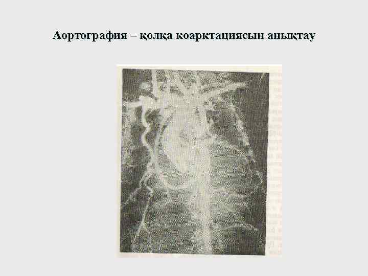 Аортография – қолқа коарктациясын анықтау 