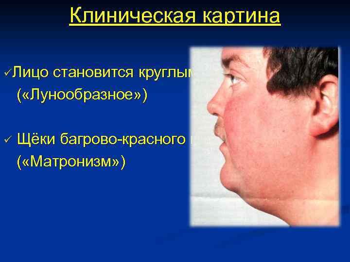 Клиническая картина üЛицо становится круглым ( «Лунообразное» ) ü Щёки багрово-красного цвета ( «Матронизм»