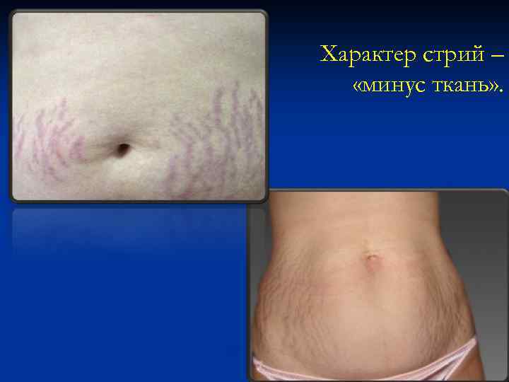 Характер стрий – «минус ткань» . 