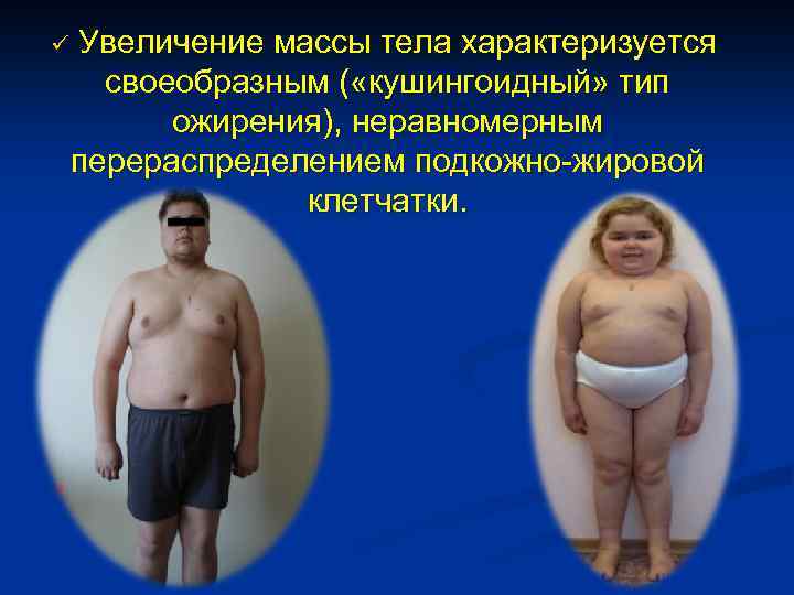 ü Увеличение массы тела характеризуется своеобразным ( «кушингоидный» тип ожирения), неравномерным перераспределением подкожно-жировой клетчатки.