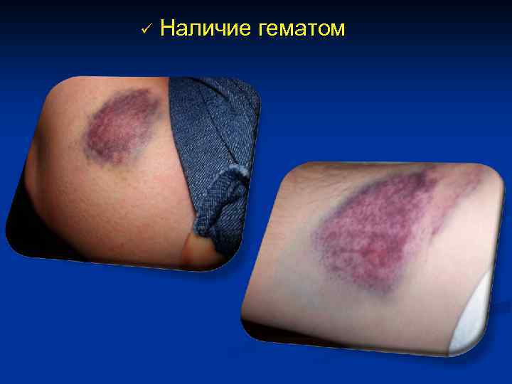 ü Наличие гематом 