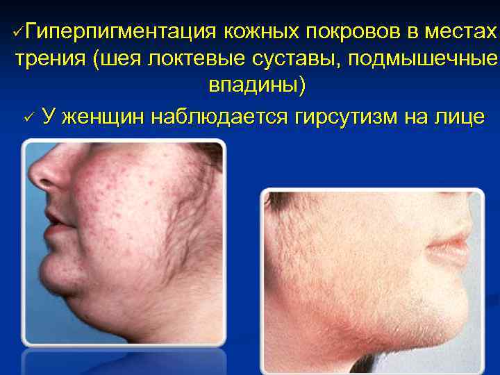 üГиперпигментация кожных покровов в местах трения (шея локтевые суставы, подмышечные впадины) ü У женщин