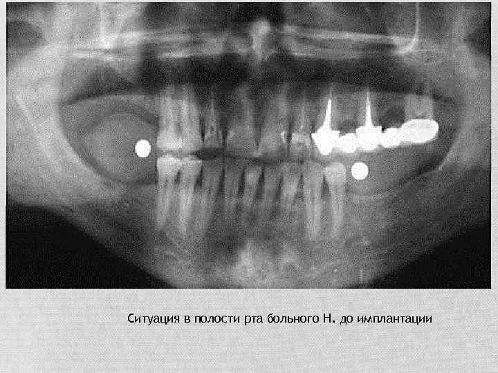 Ситуация в полости рта больного Н. до имплантации 